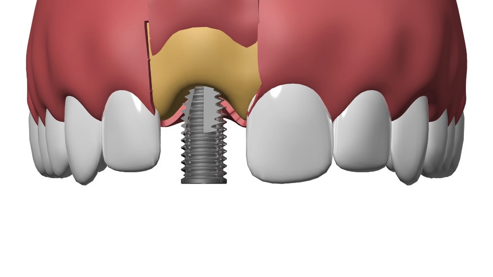 Implant dentaire Nimes